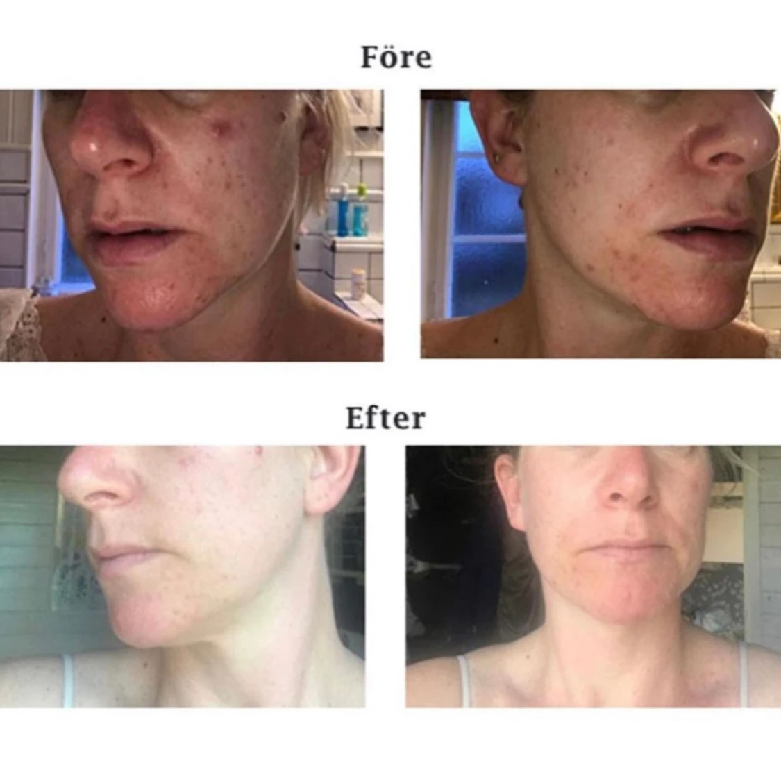 REGEN BLUE - Acne Treatment for all skins  - 91